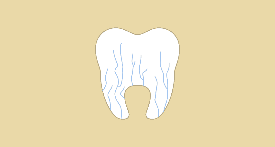 Illustration af isninger i tand