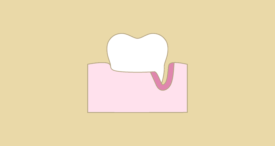 Illustration af tandkødslomme