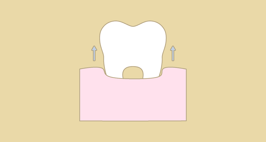 Illustration af tandudtrækning